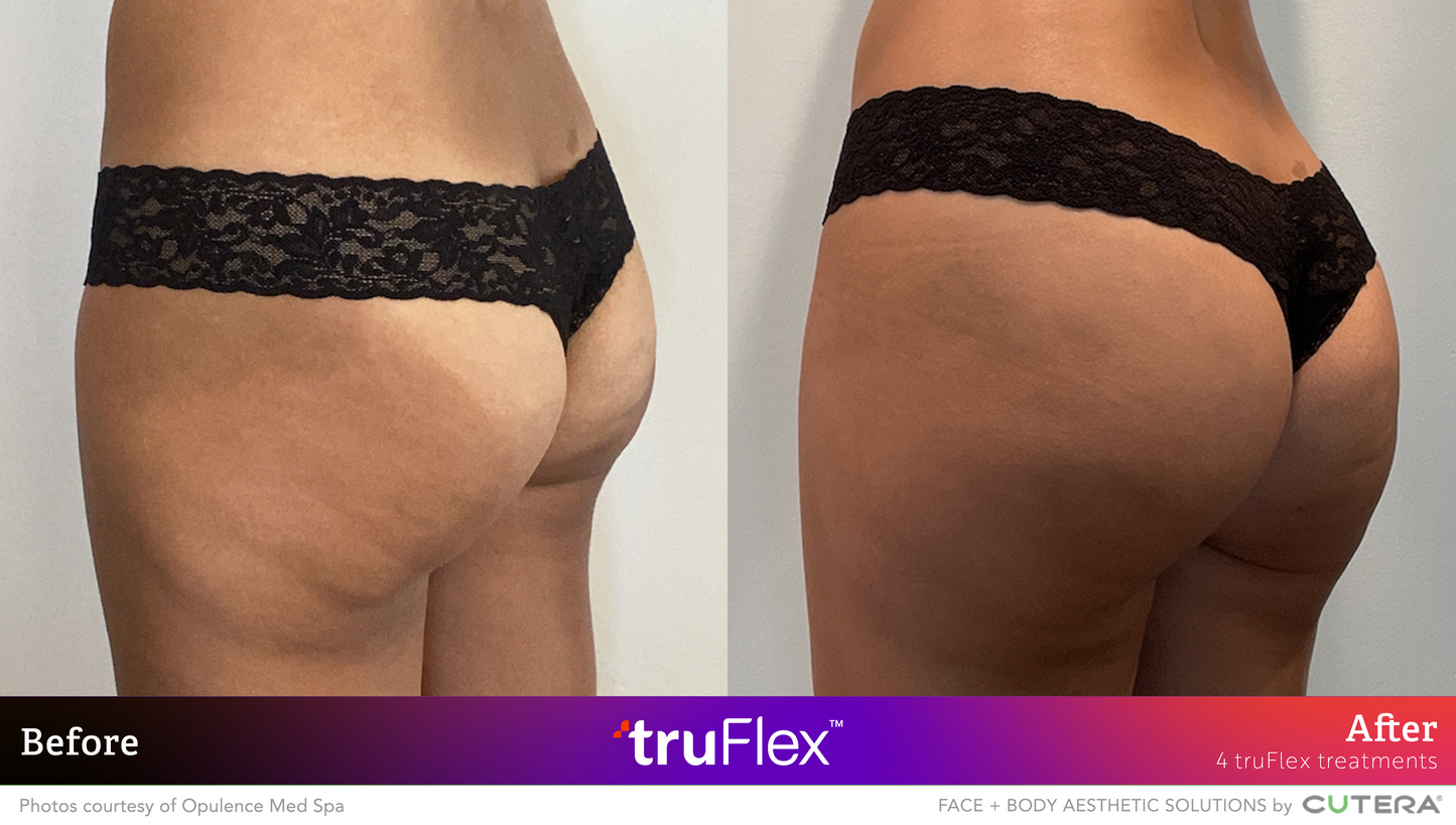 Trusculpt Flex - Tone and Firm Muscles