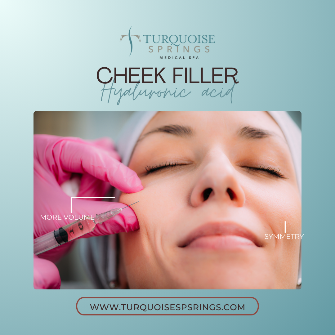 Cheek Filler (Save: $150 on 2 syringes)
