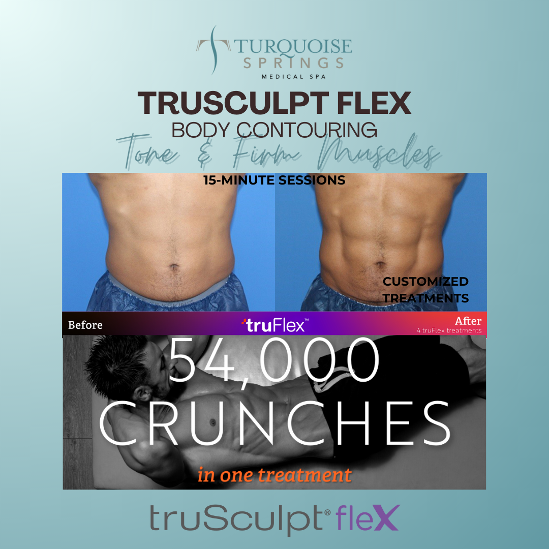 Trusculpt Flex - Tone and Firm Muscles