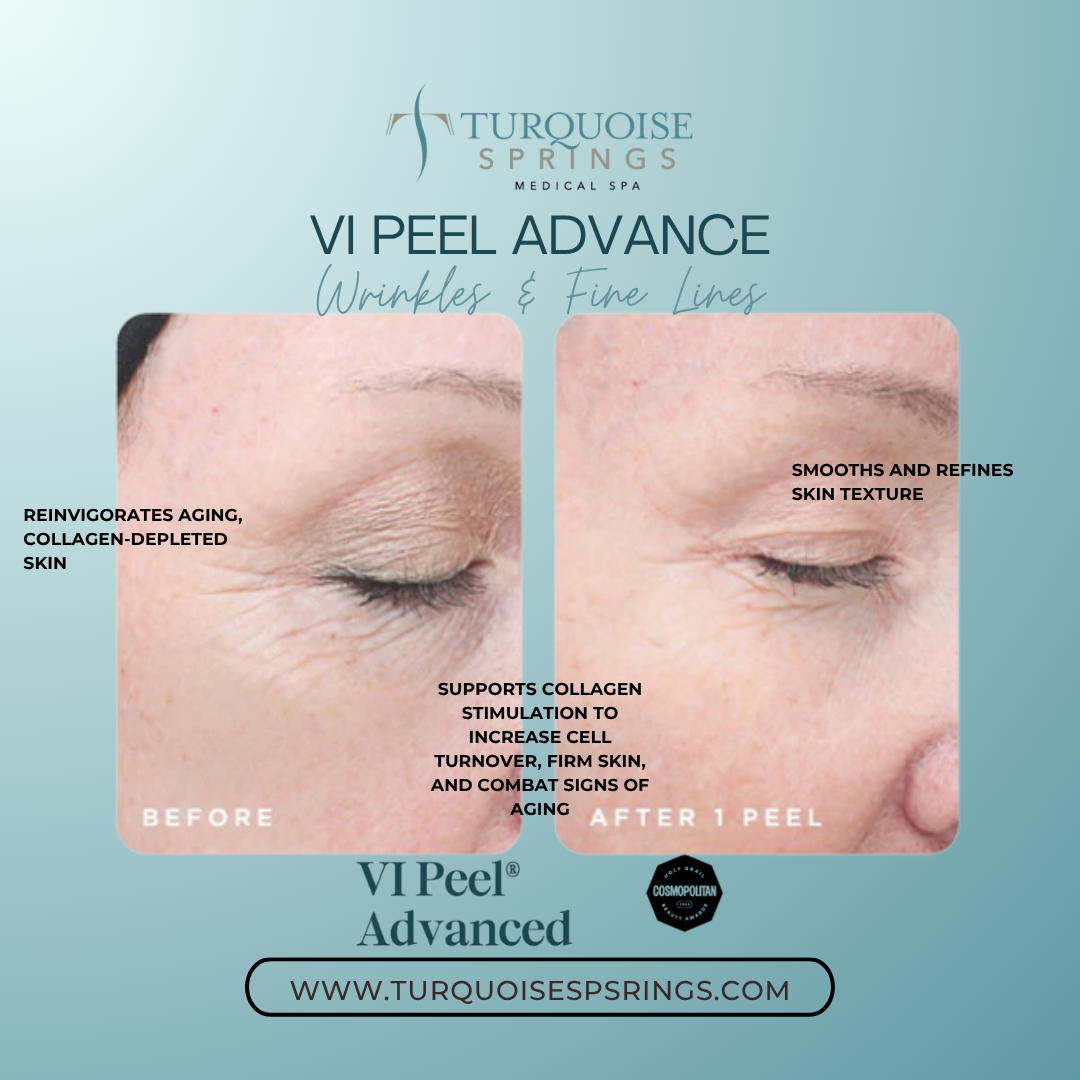VI Peel Advanced (The most popular Chemical Peel)