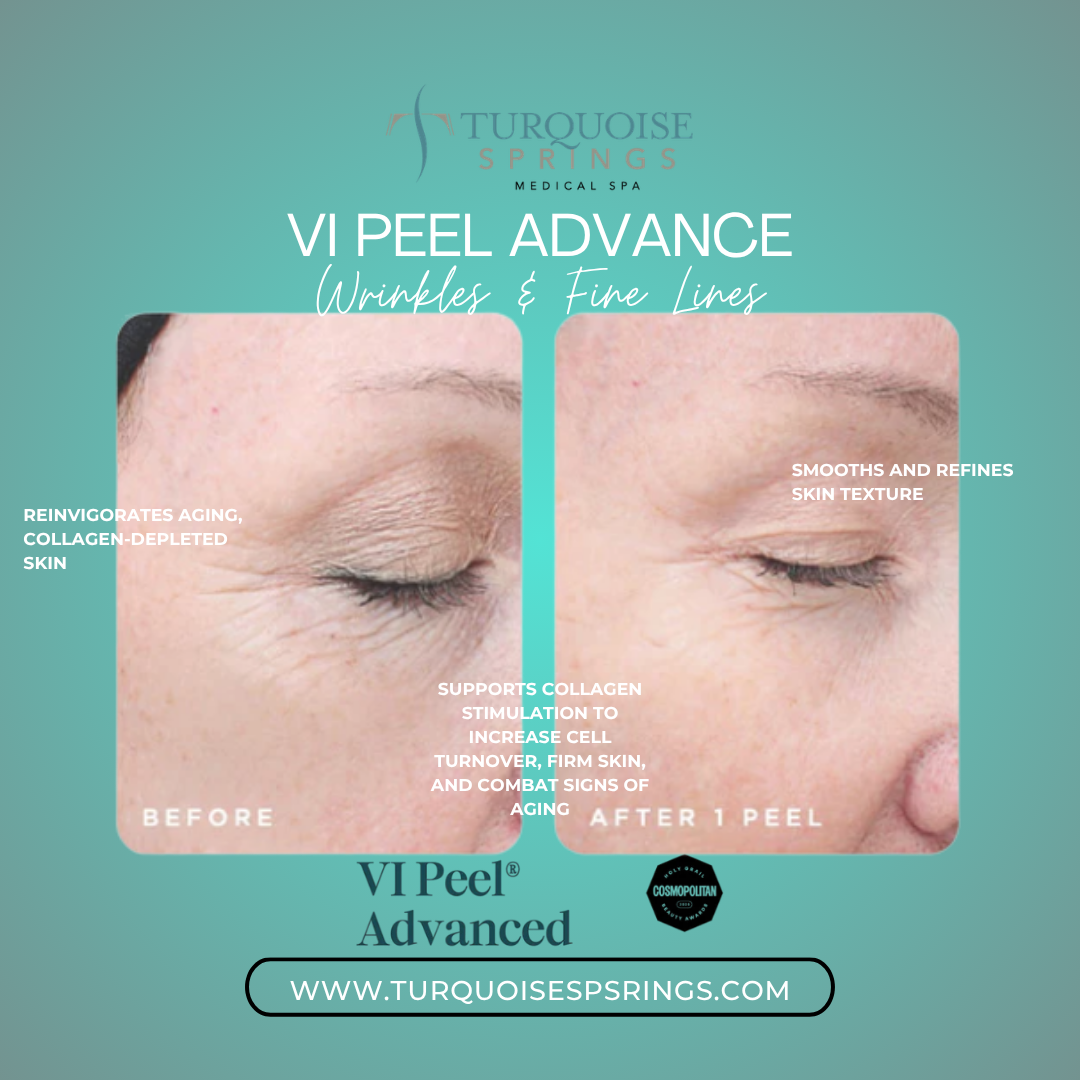 VI Peel Advanced (The most popular Chemical Peel)