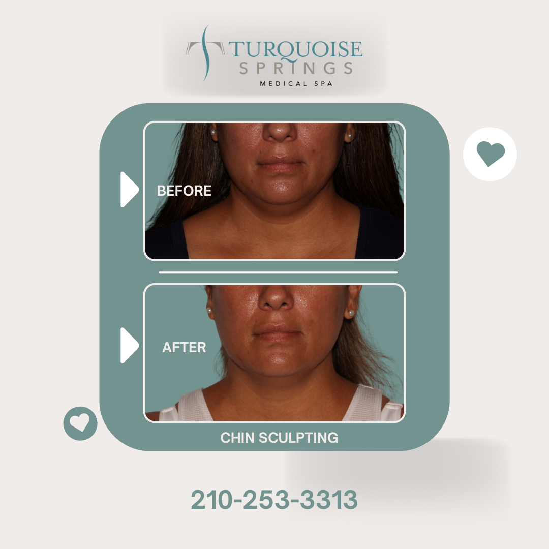 Chin Sculpting with truSculpt® Non-Surgical Treatment