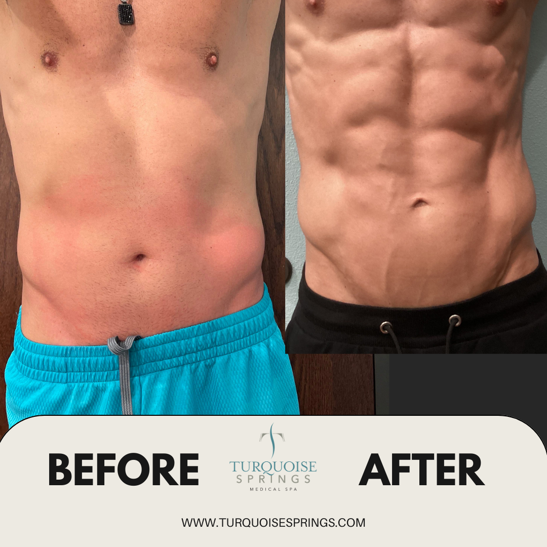 Trusculpt Flex - Tone and Firm Muscles