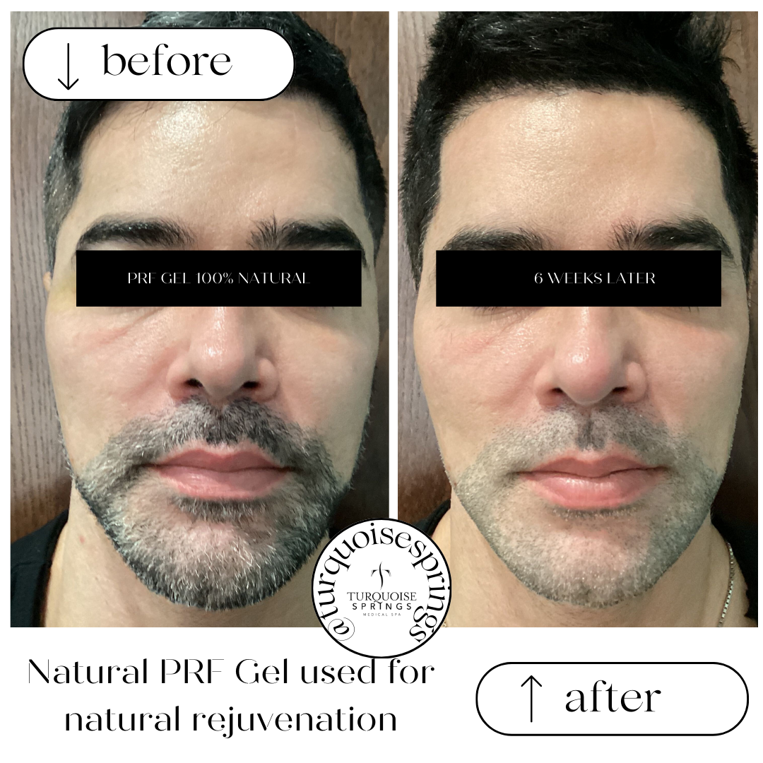 EZ Gel-All Natural Gel (derived from your own blood)