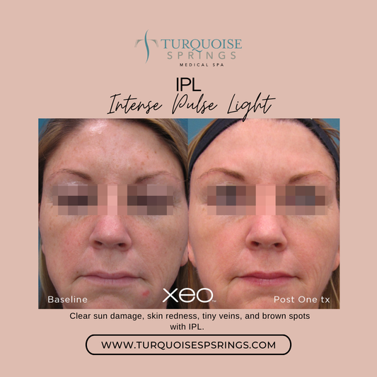 IPL Intense Pulse Light (Face)