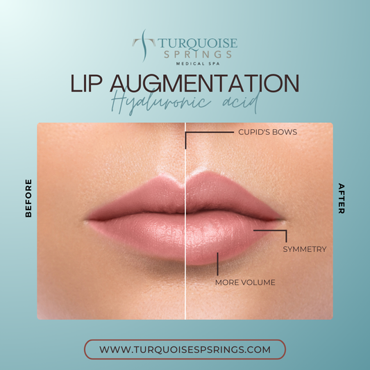 Lip Filler
