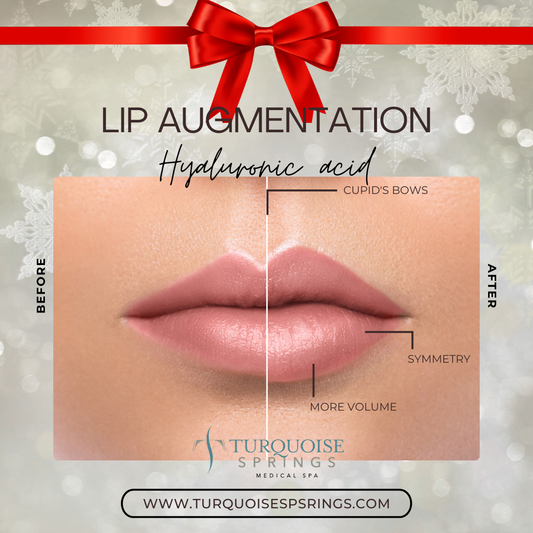 Lip Filler (Save $150)