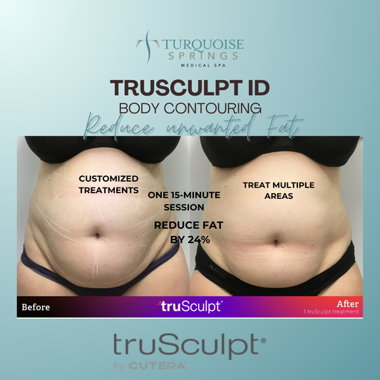 Trusculpt ID - Reduce Fat