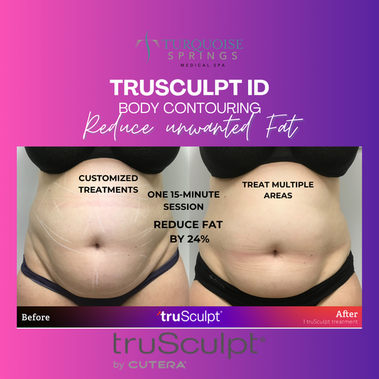 Trusculpt ID - Reduce Fat