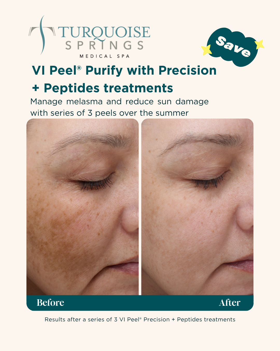 VI Peel Precision + Peptides