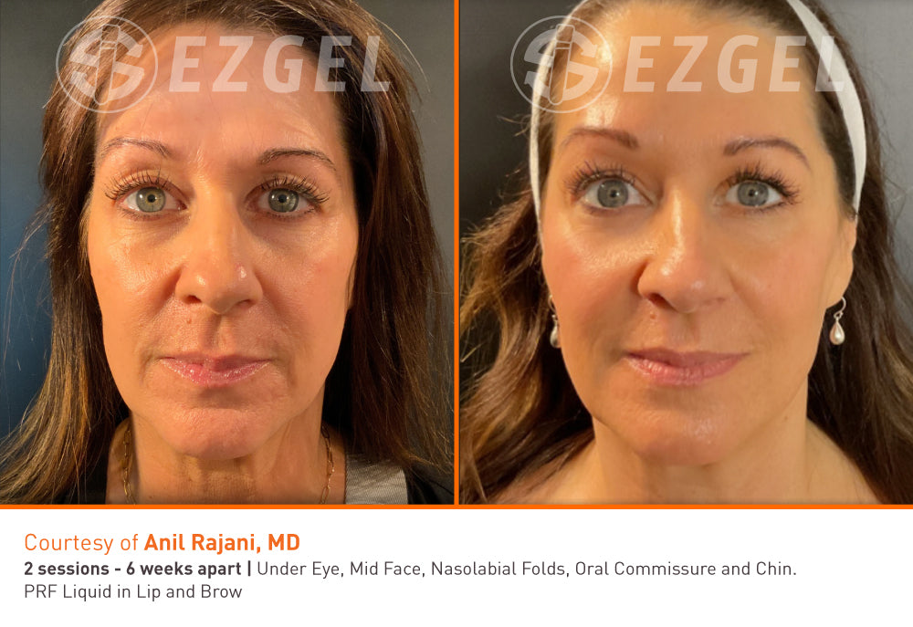 EZ Gel-All Natural Gel (derived from your own blood)